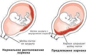 Что такое предлежание хориона Предлежание хориона: понятие