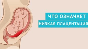 Что предпринять при низкой плацентации Что предпринять при низкой плацентации беременной