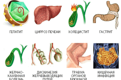 Причины панкреатита Причины панкреатита