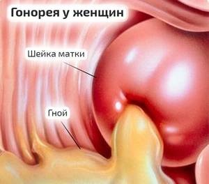 Причины болезни и факторы риска гонореи