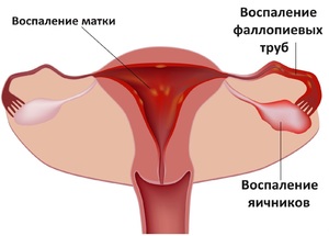 Причины образования эрозии