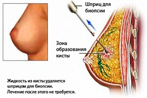 Причины появления кисты