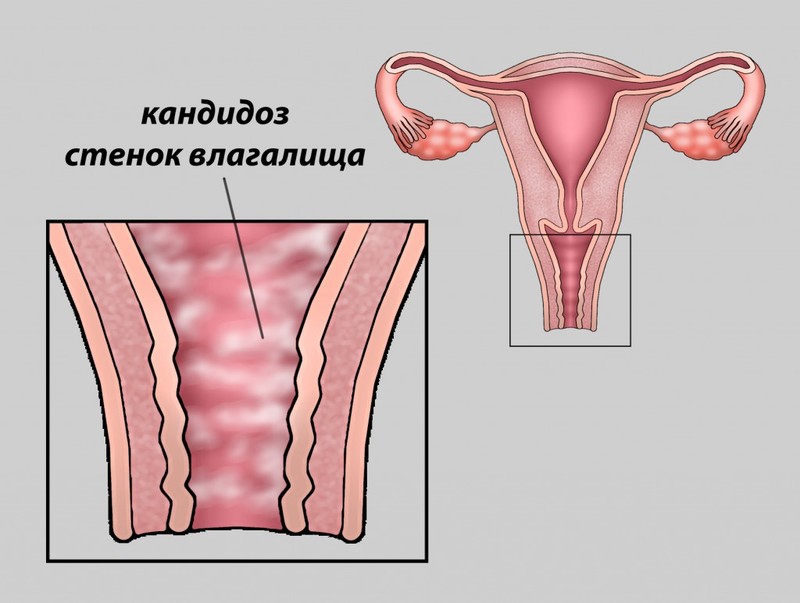 Причины появления молочницы у женщин и мужчин