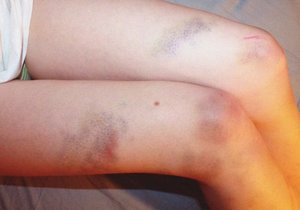 Поверхностный синяк на ноге Причины синяком на ногах