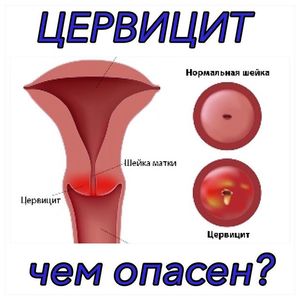 Причины и виды гинекогологической болезни