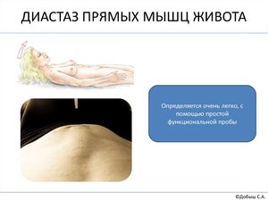 Диастаз прямых мышц Причины возникновения заболевания