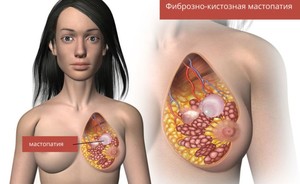 Причины возникновения и симптомы фиброзно-кистозной мастопатии