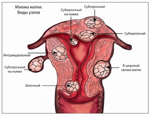 признаки миомы матки