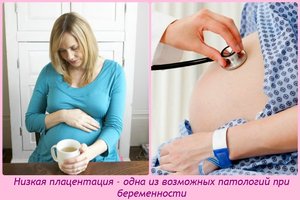 Признаки низкой плацентации Признаки низкой плацентации при беременности