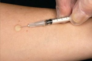 Проба Манту