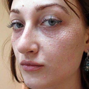 Процедура биогевитализация
