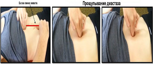 Диагностирование заболевания Прощупывания диастаза