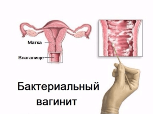 Беременность и заболевание Как протекает заболевание вагиноз