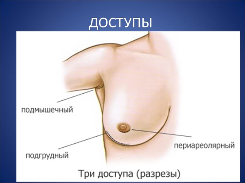 Противопоказания самообследования молочных желез