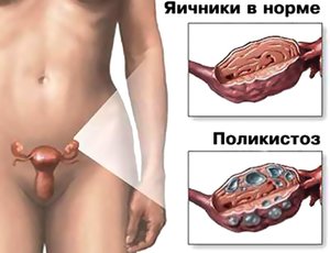 Как проявляется заболевание поликистоз