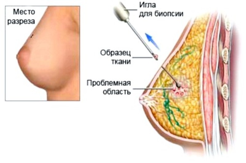 Пункция молочной железы последствия