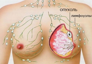Рак молочной железы