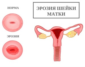 Рак шейки матки