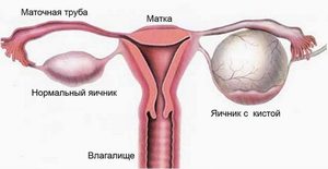 Разновидности кисты