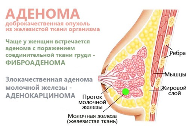 Развитие фиброаденомы у женщин