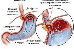 Рефлюкс - последствие панкреатического блока Рефлюкс - последствие панкреатического блока