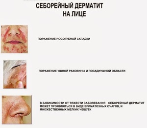 Себорейный дерматит