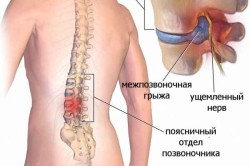 Схема панкреатита Схема панкреатита