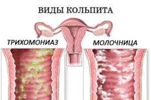 Схема лечения трихомониаза