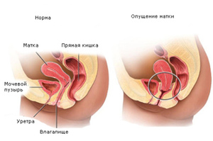 Симптомы опущения матки на разных стадиях