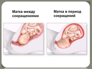 Тонус при беременности Симптомы тонуса
