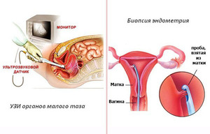Сложная гиперплазия эндометрия
