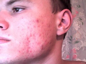 Состав и полезные свойства пивных дрожжей для кожи