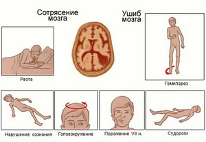 Сотрясение у ребенка симптомы