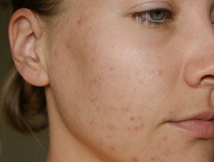 Как избавиться от прыщей Способы избавления от прыщей
