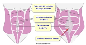 Определение диастаза Способы лечения заболевания
