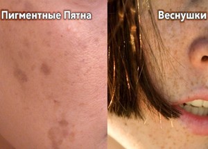 Пигментные пятна на лице: причины, как убрать Сравнение пигментных пятен