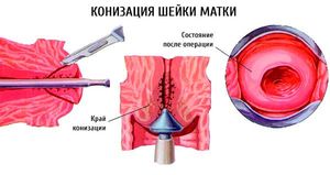 Средства лечения эрозии шейки матки