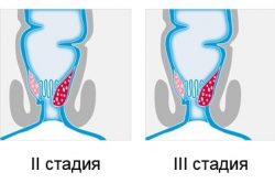 Стадии геморроя Стадии геморроя