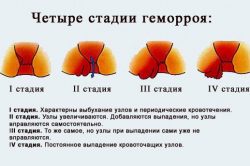 Стадии геморроя Стадии геморроя
