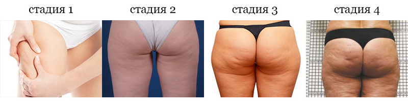 Стадии целлюлита на попе