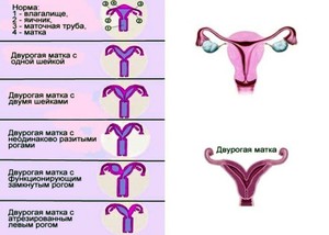 Что означает диагноз двурогая матка Стоит ли лечить двурогую матку