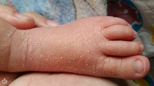 Сухая кожа у новорожденного