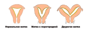 Что значит диагноз двурогая матка Что такое двурогая матка