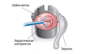Что такое конизация шейки матки и как она проходит
