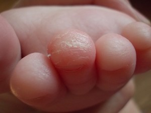Трескаются пальцы на руках