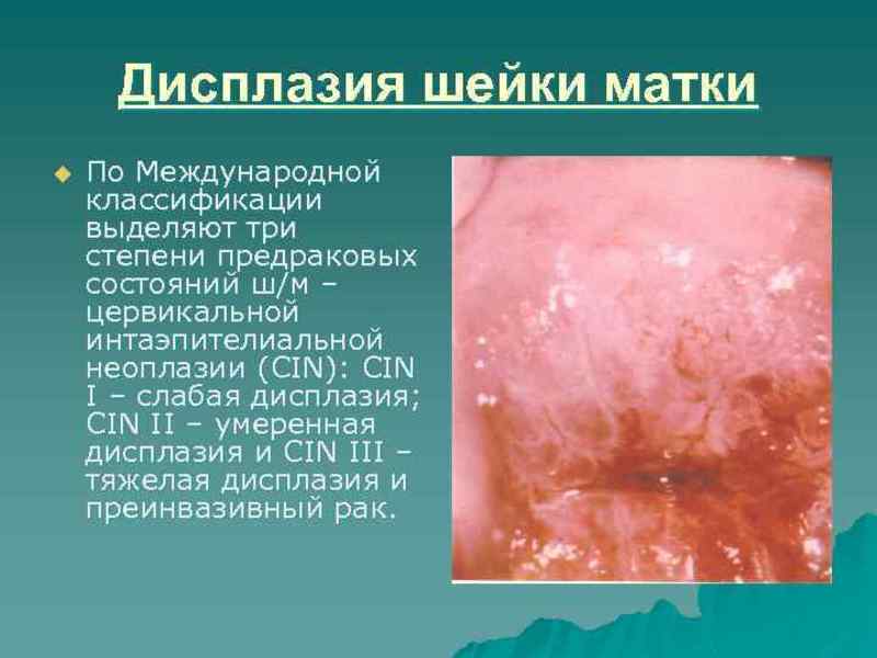 Тяжелая дисплазия шейки матки 3 степени