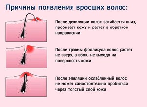 Удаление вросших волос