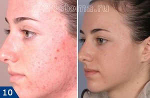 Уход за лицом после алмазной шлифовки лица Как ухаживать за лицом после алмазного пилинга