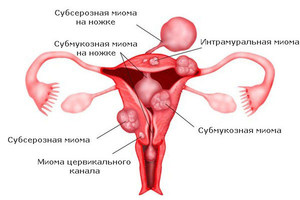 Узловая миома