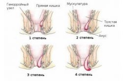 Степени геморроя Степени геморроя
